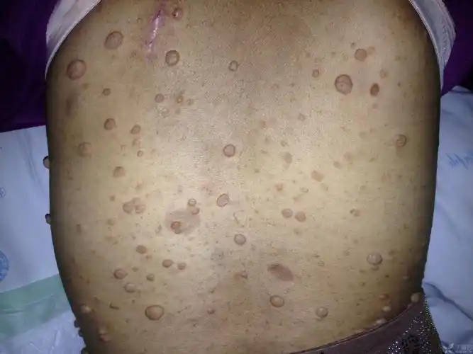 【讨论】我来发个皮肤神经纤维瘤,大家是否有不同意见 [病例帖]