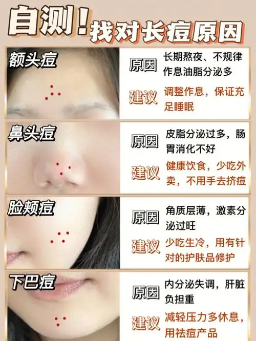 不同位置痘痘原因|破解烂脸超全护肤攻略