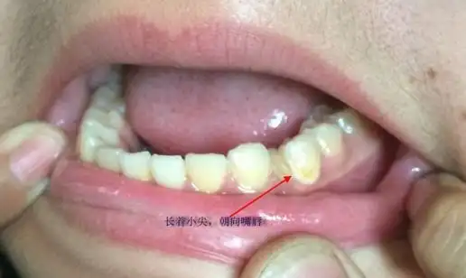 怎么回事呢,两牙之间长了小牙?