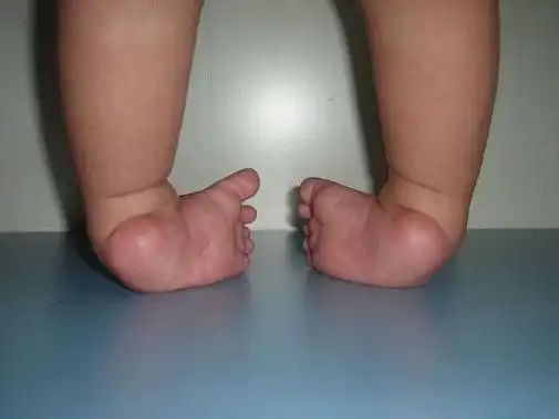 如果家长发现孩子有足内翻,脚后跟朝上,踝关节下垂等表现,那么就要