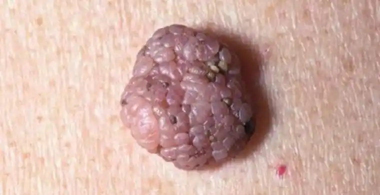 疣状的一个大半球状的比如形成皮内痣最终在表皮内毫无残留直到完全