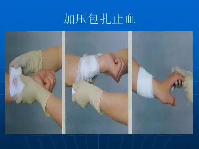 加压包扎止血