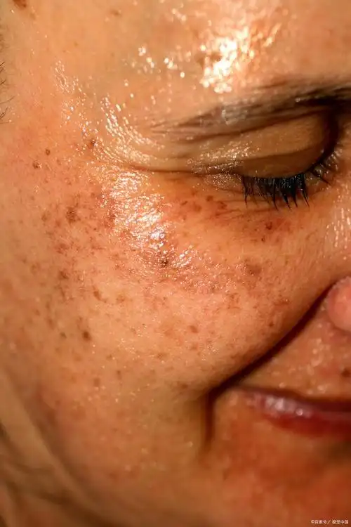 黄褐斑难祛的原因,有以下4种,大家切记