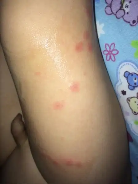 宝宝过敏全身长满了红疹怎么处理 二个月宝宝突然起红