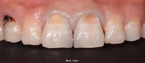 1121邻面龋唇侧颈部龋