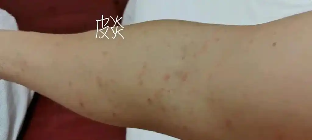 皮肤瘙痒 别手挠以免皮肤感染 形成皮炎或皮肤癣 - 抖音