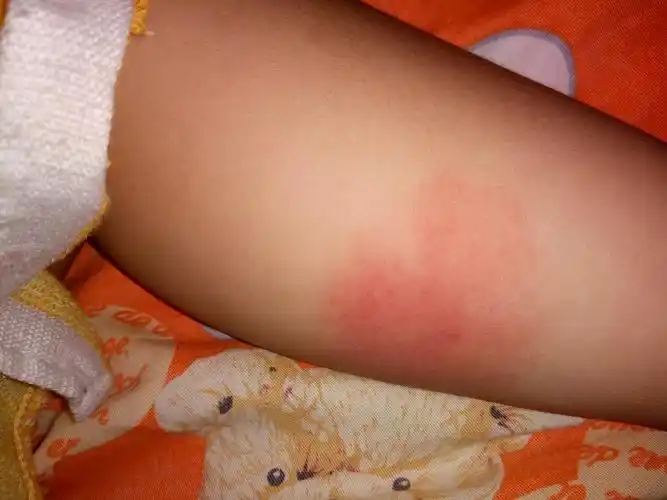 宝宝腿上是什么