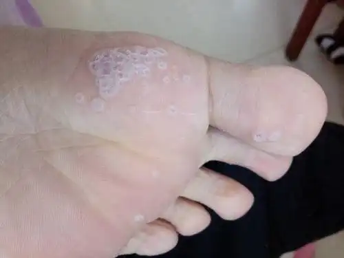 脚底有一片很明显的蜂窝状,平时不痛不痒,也不明显,就是一泡脚就明显