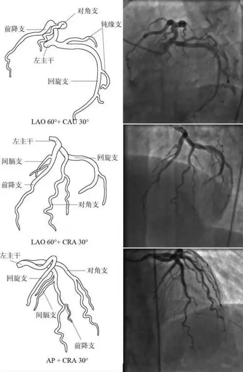 冠脉造影——诊断冠心病的"金标准"