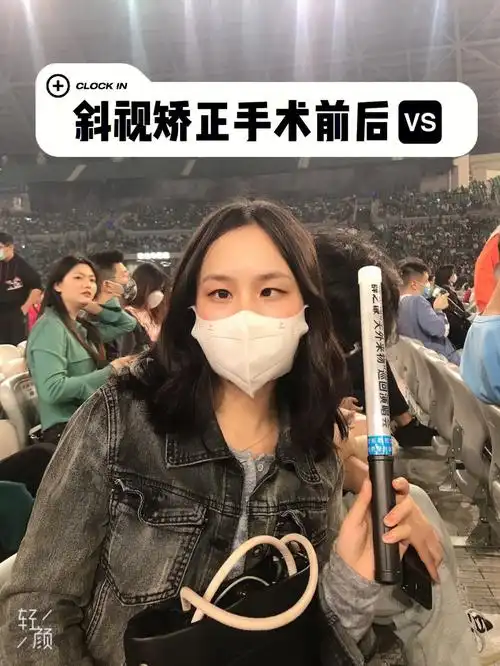 斜视手术后79天后的效果对比