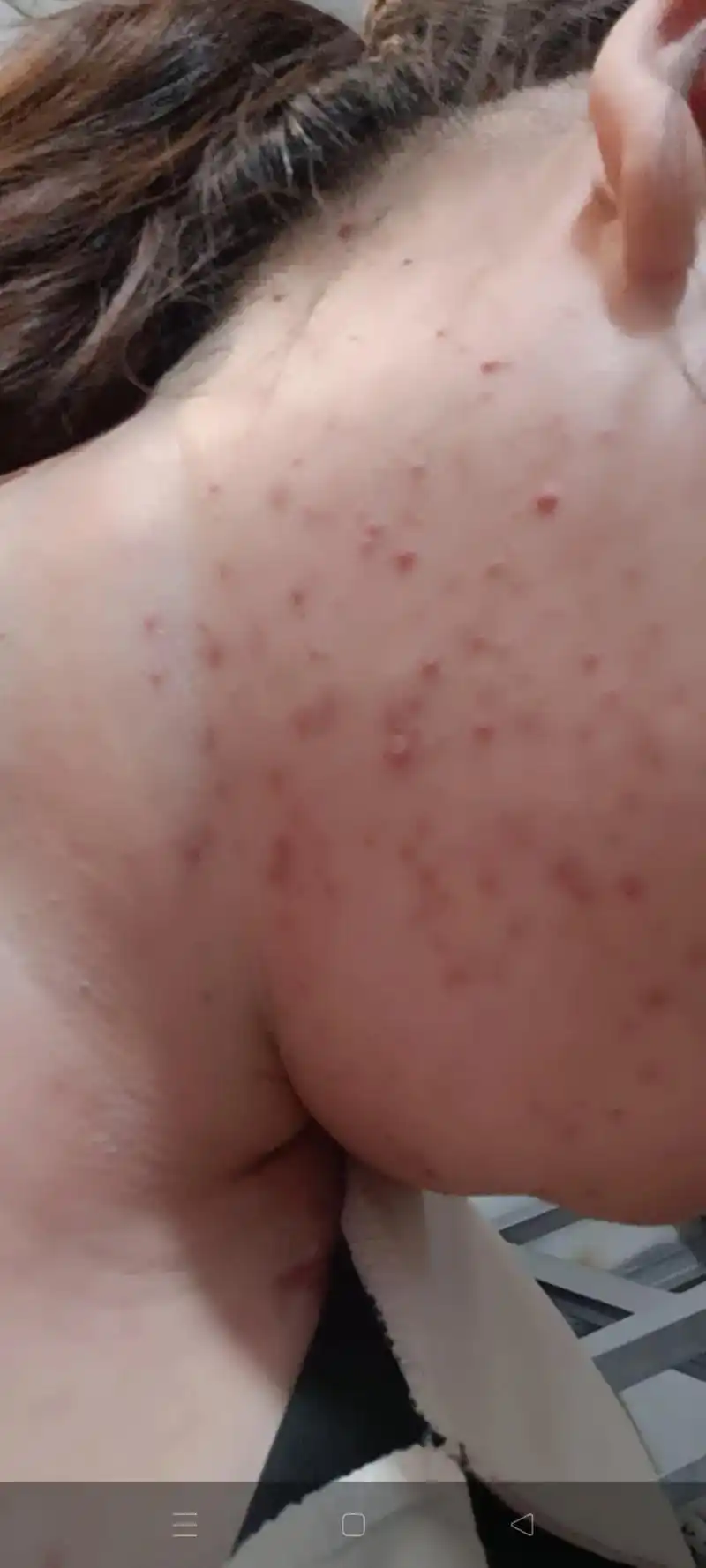 告别痘痘肌 #皮肤问题 #爆痘 ,一样未好一样又来真服了自 - 抖音