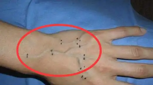 为什么有人手背上的青筋很粗很明显真实情况让人大惊失色