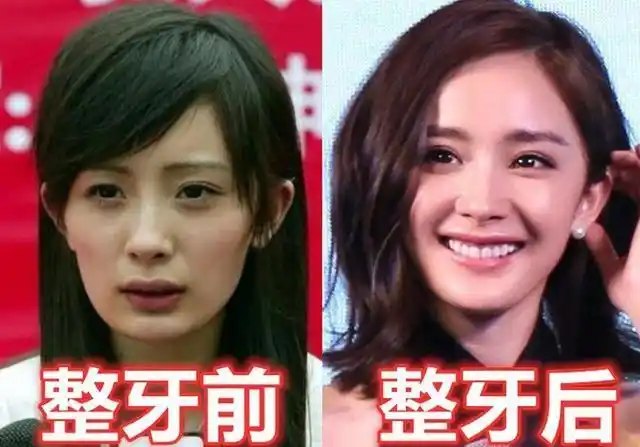 降低了颜值,所以很多人也是坚信整牙如整容,整牙之后能够改变脸型,让