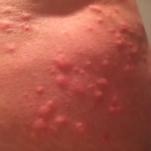 前段时间身上发一个一个红点,之后连成一片了,现在涂了药膏,肚子上好