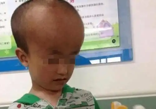 痛心三鹿奶粉十二年后又现大头娃娃悲剧谁来保护孩子