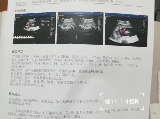 在27-28周b超时,宝宝脐带绕颈两周,还伴随臀位,为娘终日忐忑不安,伴随