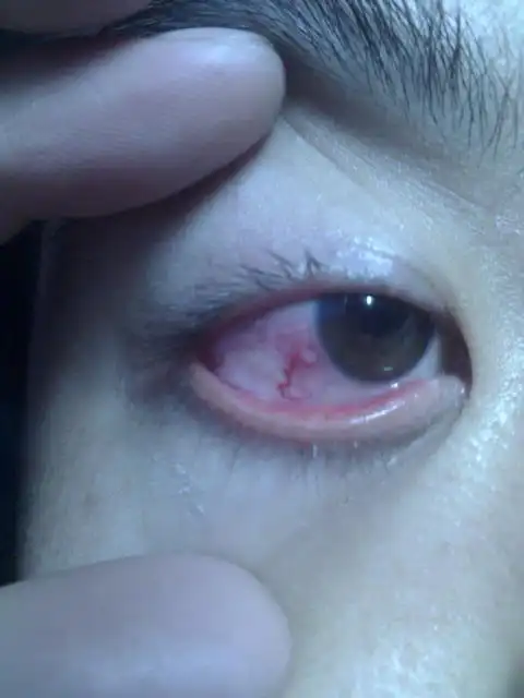 白眼球靠近黑眼球处长了一个米粒大小的白点,请问是泡性结膜炎吗?