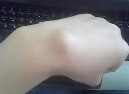 妈妈手手机手患上腱鞘炎苦不堪言艾灸治疗管用吗