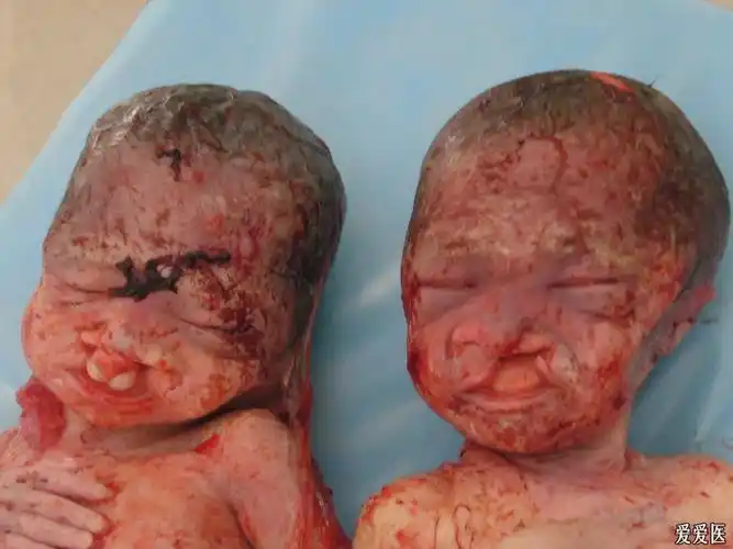 双胎唇裂合并腭裂