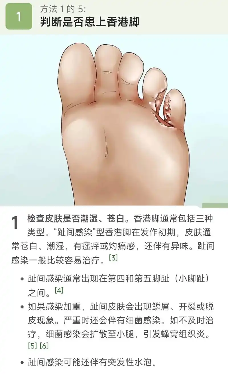 如何治疗和预防香港脚.脚癣",俗称香港脚,是足部皮肤受真菌感 - 抖音