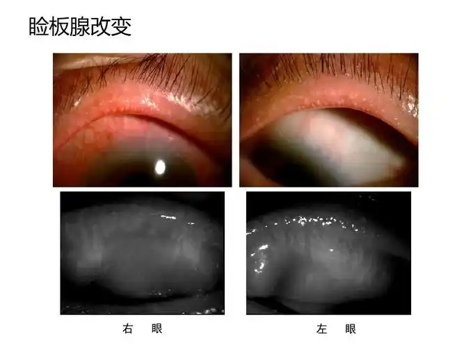 睑板腺改变 右 眼 左 眼