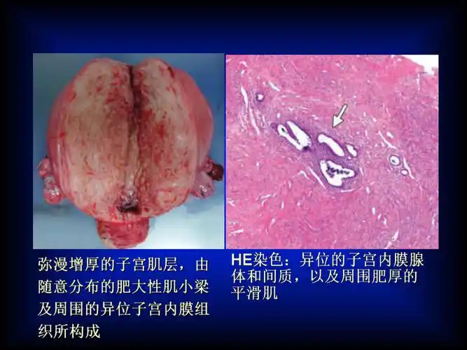子宫腺肌症的mri表现