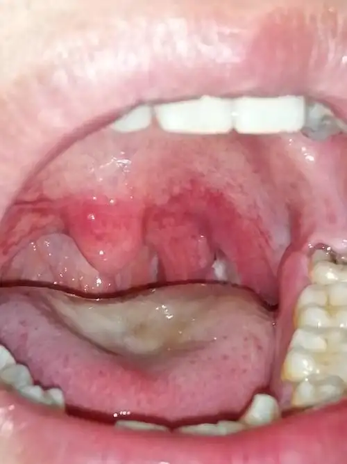 喝水,咽口水都疼是怎么回事,白色哪里像泡一样的是