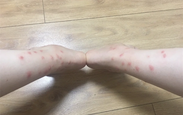 蚊子是有毒吗……把我的腿咬成这样了
