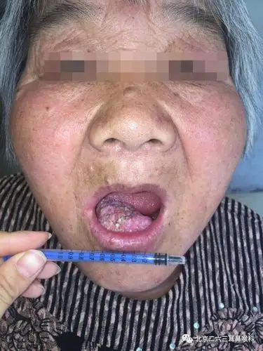 病例回顾牙龈癌龈颌颈联合根治前臂游离皮瓣移植腹部游离皮片移植术