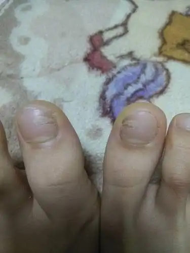 脚趾甲中间空了一块,请问是怎么回事?