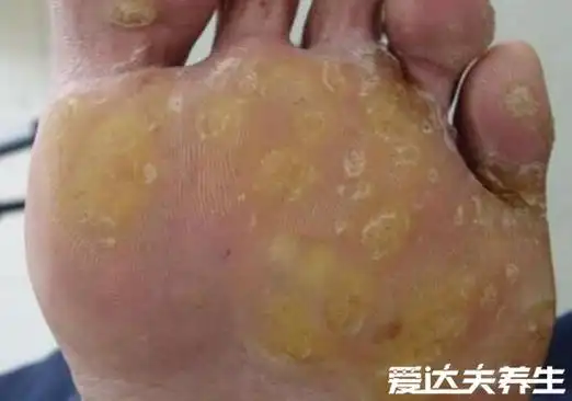 脚上长鸡眼图片,外形像鸡的眼睛疼痛感强(胆小者慎入)