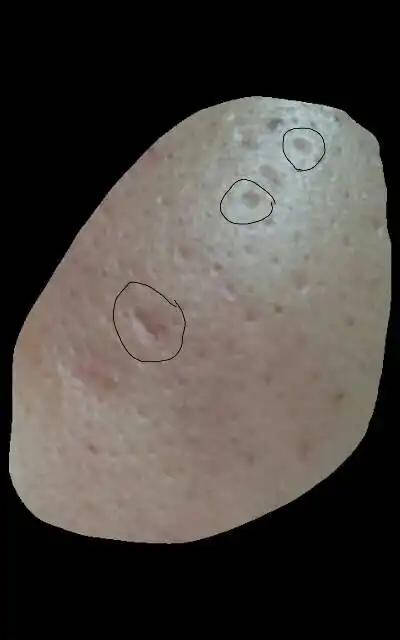 这种脸上小凹陷怎么去除呢?