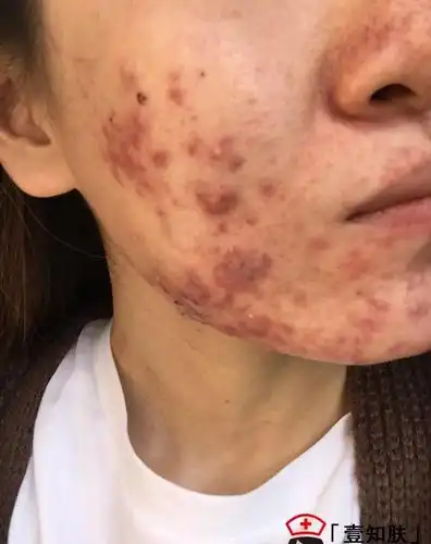 成功赶走痘痘涅盘重生完整记录一个女生的战痘经历