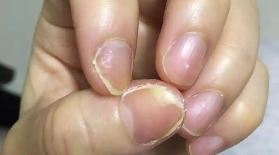 指甲出现这2种变化,肾或许早晚要透支 67