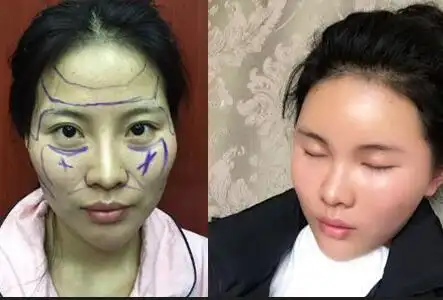 自体脂肪填充面部前后对比图,自体脂肪填充太阳穴,额头