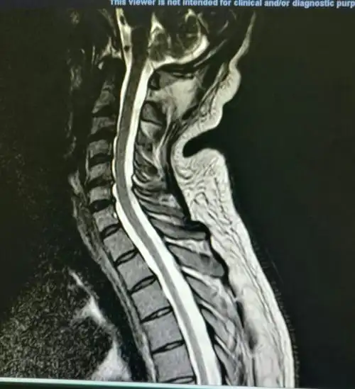 颈椎病 腰椎间盘突出