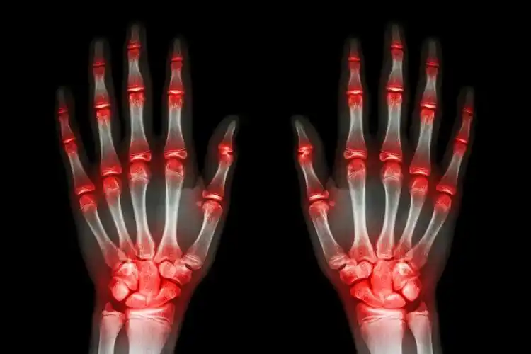 手部关节疼痛特写渲染