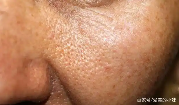 长期不去角质,皮肤细胞代谢周期变长,常见的皮肤粗糙,毛孔粗大,肤色暗