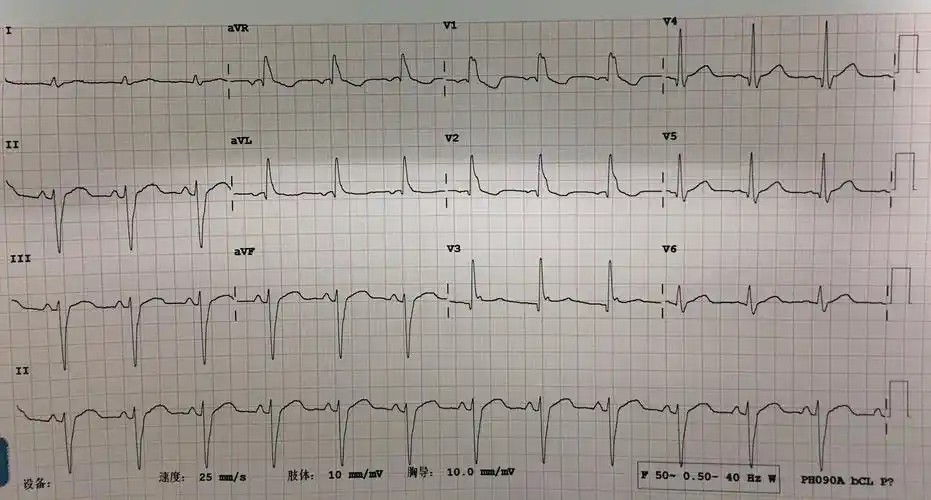 注册x  男,80岁请问老师这个心电图是前壁异常q波吗