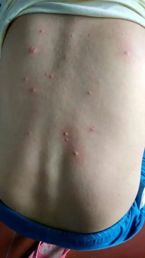 背上睡醒超级痒看了下长了一粒一粒的东西,和蚊子咬