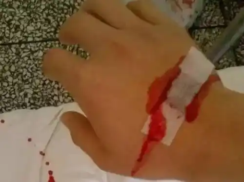 护士必看:扎针,拔针有技巧,一点都不疼!