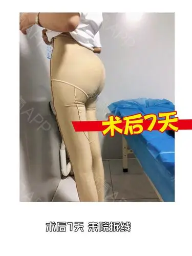 【案例分享】360°立体精雕吸脂塑臀