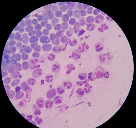 肺里涨水到底是啥原因这六点需要注意最严重的是肺癌