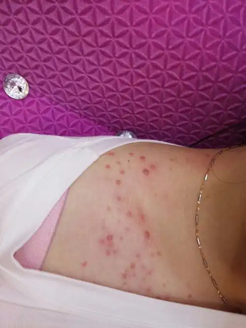 胸前长好多一粒粒红红有水有挤不出来的,什么原因