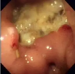 几张胃溃疡图片