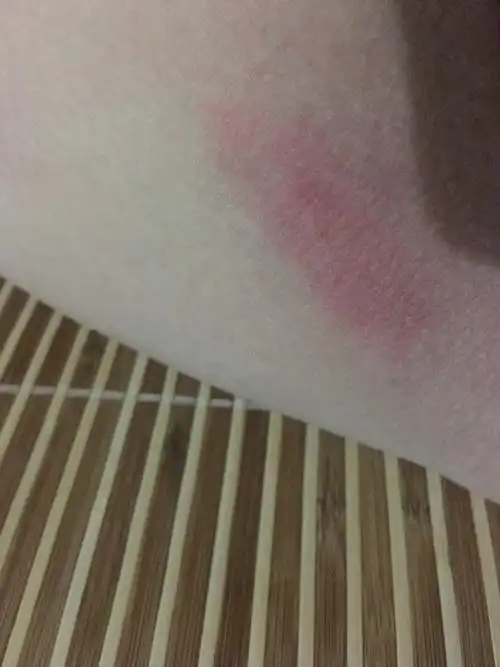 大腿内侧皮肤红肿,衣服摩擦时候疼是怎么回事?