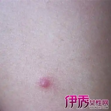 二,成年男性的艾滋病潜伏期症状