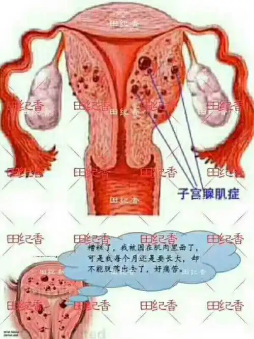 子宫腺肌症