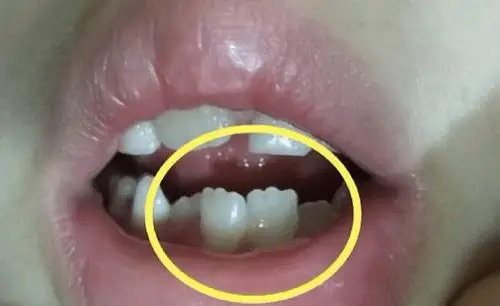 小孩换牙期牙齿呈锯齿状?六安竹子口腔医院为你科普!