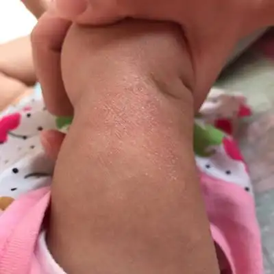 是湿疹还是皮肤问题还是过敏体质.